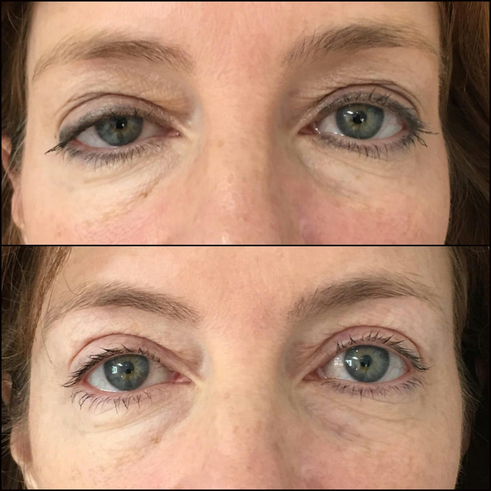 Ptosis Repair Before & After Gallery - Patient 53591908 - Image 1