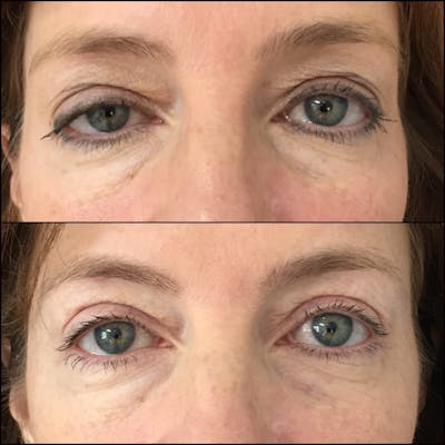 Ptosis Repair Before & After Gallery - Patient 53591908 - Image 1