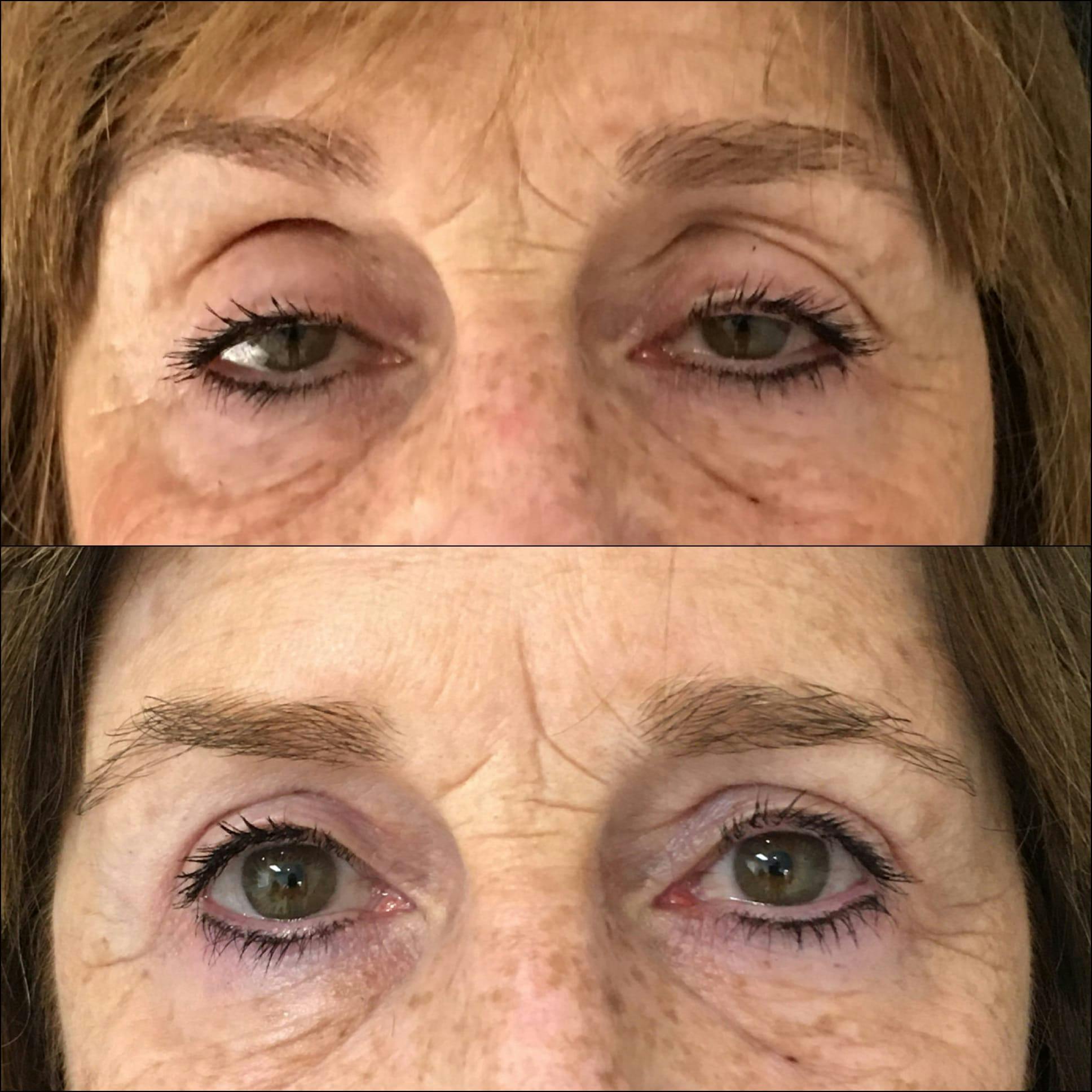 Ptosis Repair Before & After Gallery - Patient 53591909 - Image 1