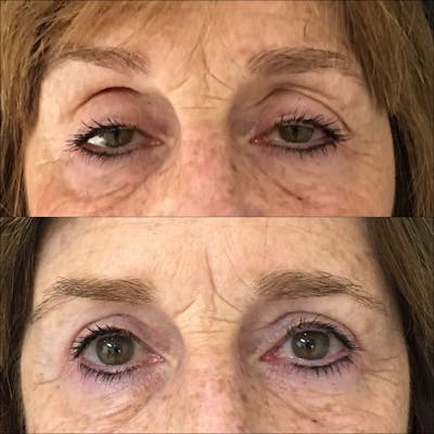 Ptosis Repair Before & After Gallery - Patient 53591909 - Image 1