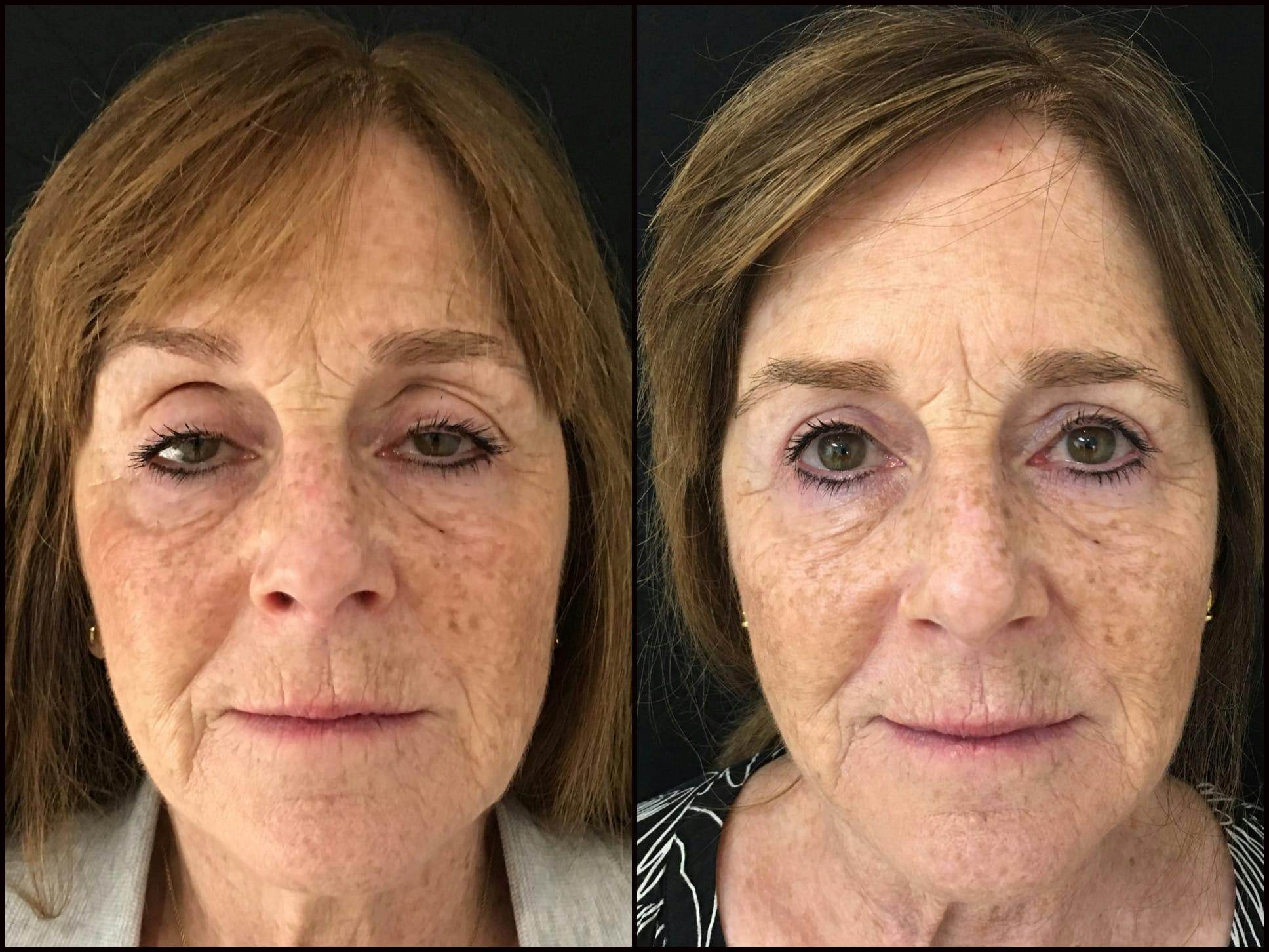 Ptosis Repair Before & After Gallery - Patient 53591909 - Image 2