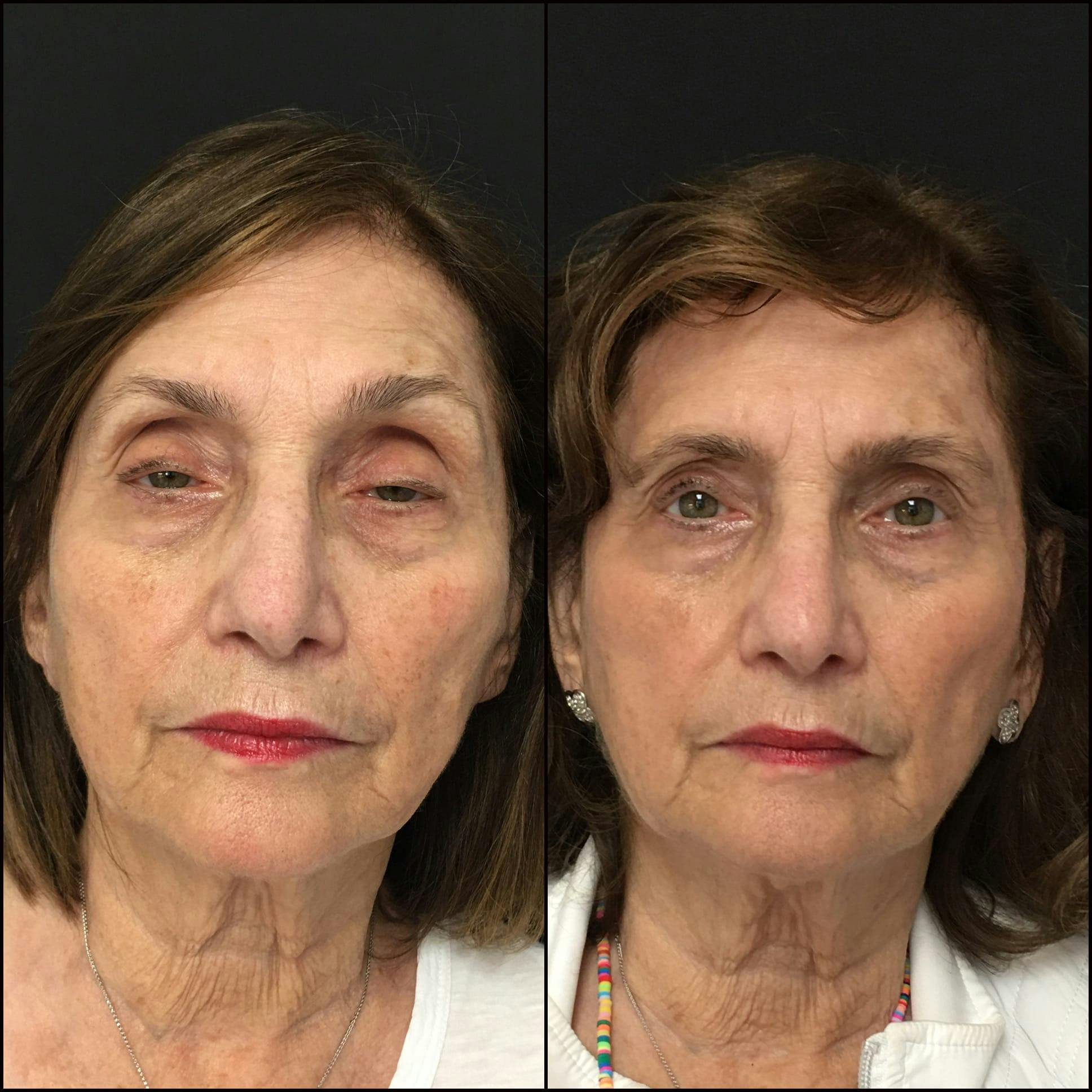 Ptosis Repair Before & After Gallery - Patient 53591911 - Image 1