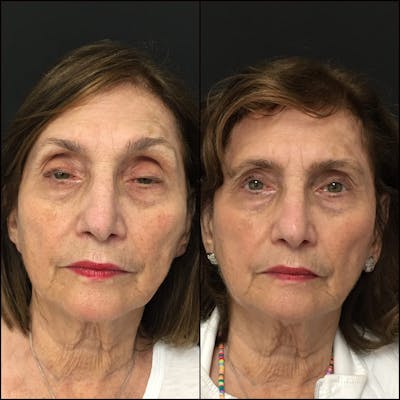 Ptosis Repair Before & After Gallery - Patient 53591911 - Image 1