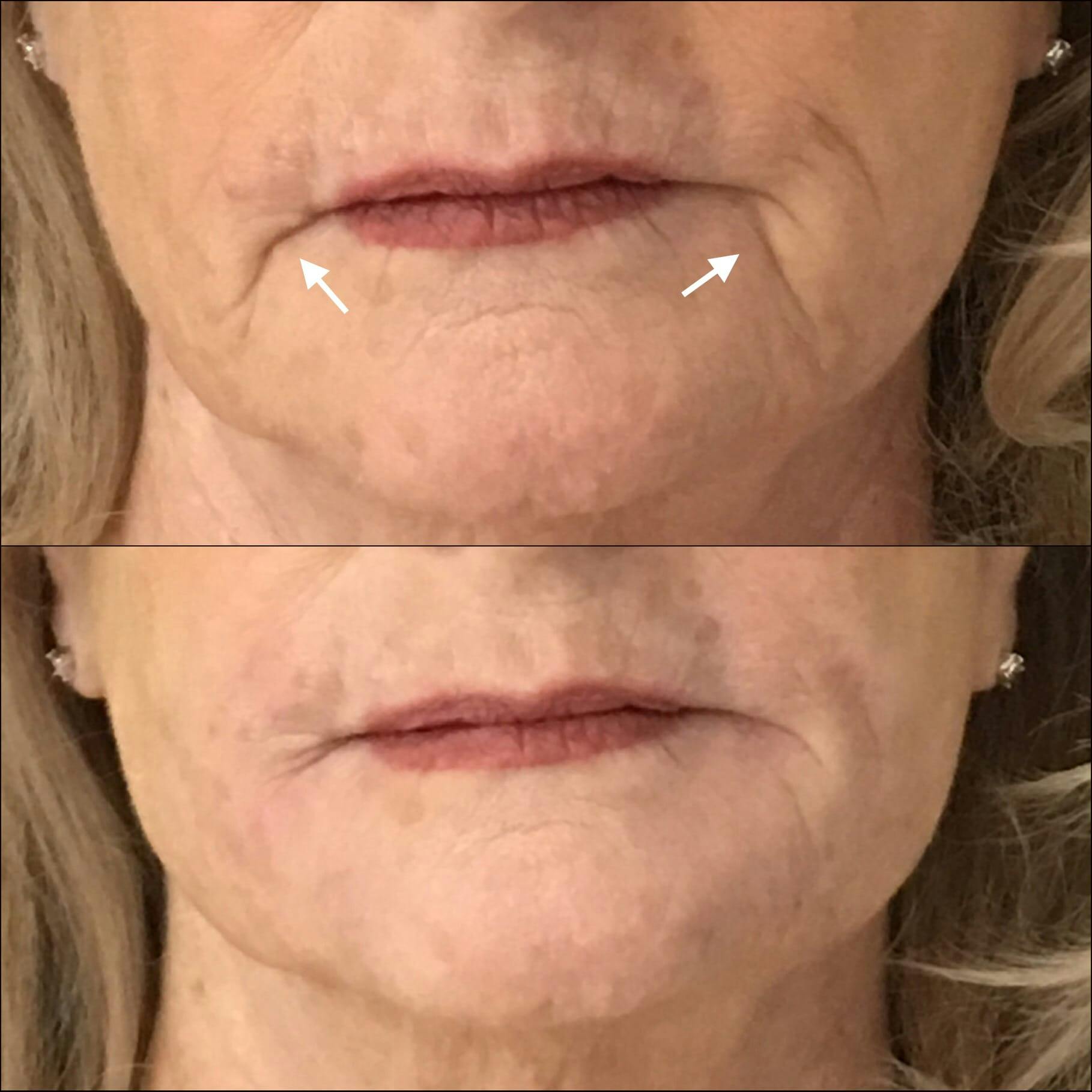 Dermal Fillers Before & After Gallery - Patient 53591924 - Image 1
