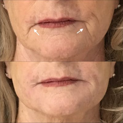 Dermal Fillers Before & After Gallery - Patient 53591924 - Image 1