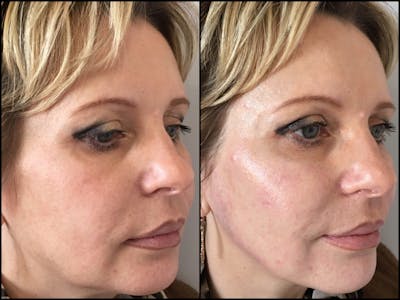 Dermal Fillers Before & After Gallery - Patient 53591925 - Image 1