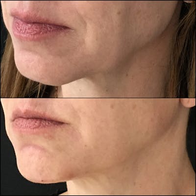Dermal Fillers Before & After Gallery - Patient 53591927 - Image 1