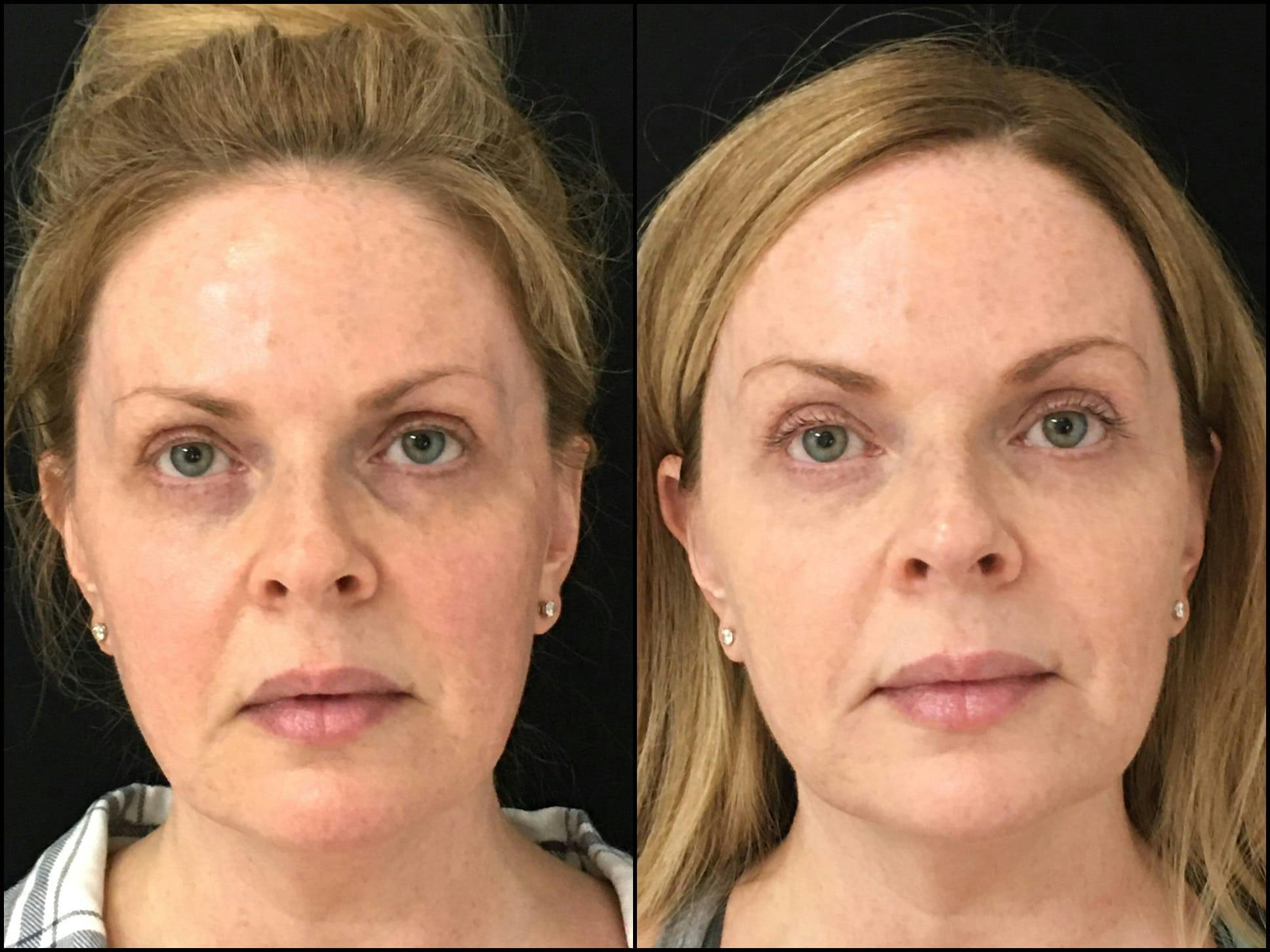 Dermal Fillers Before & After Gallery - Patient 53591929 - Image 1