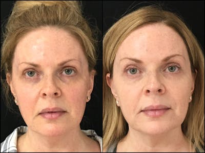 Dermal Fillers Before & After Gallery - Patient 53591929 - Image 1