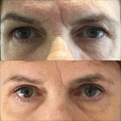 Brow Lift Before & After Gallery - Patient 53591933 - Image 1