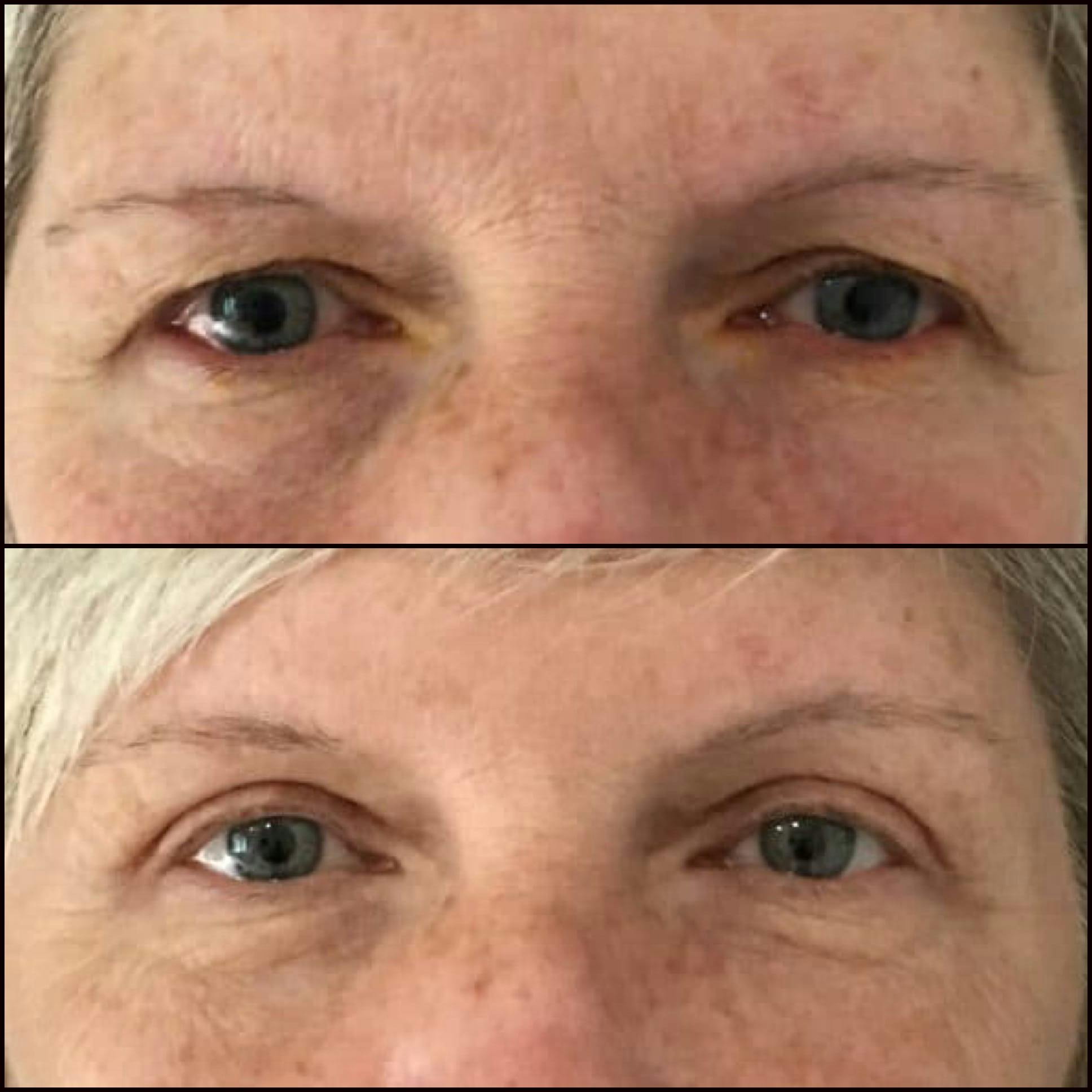 Brow Lift Before & After Gallery - Patient 53591934 - Image 1