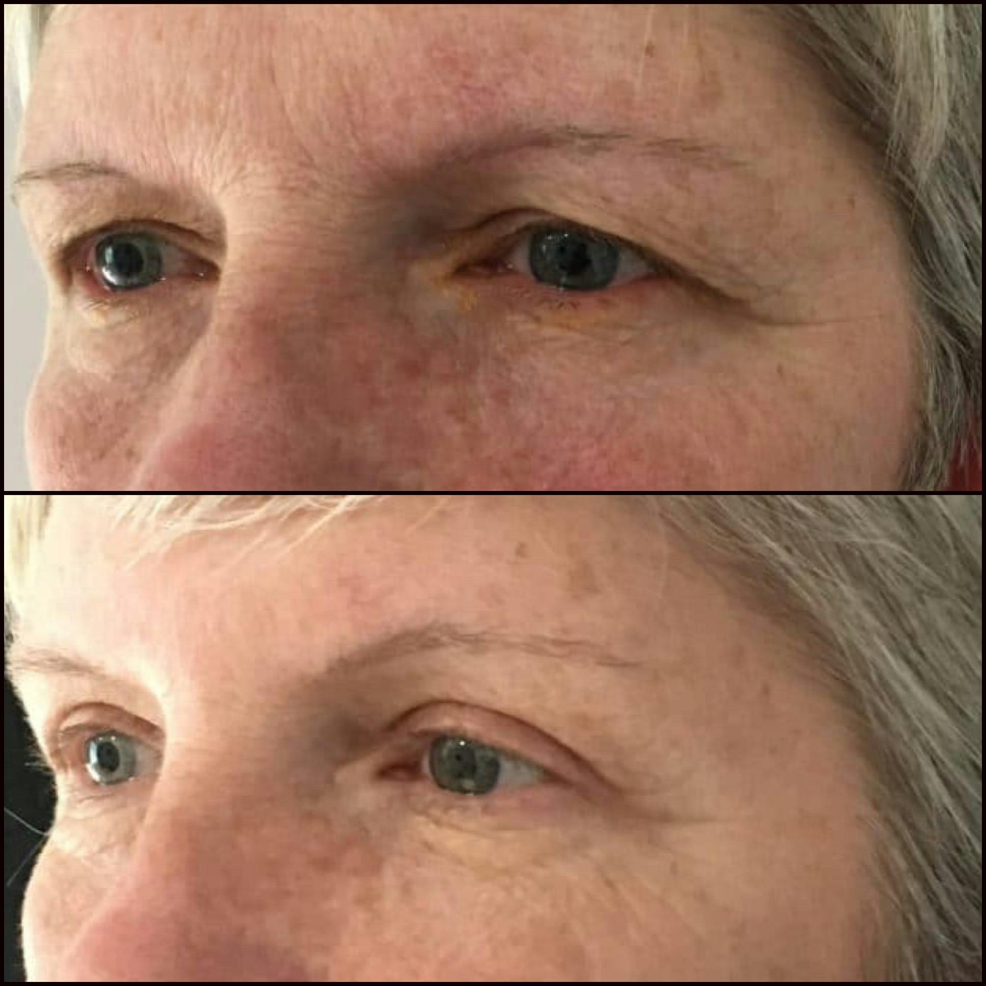 Brow Lift Before & After Gallery - Patient 53591934 - Image 2