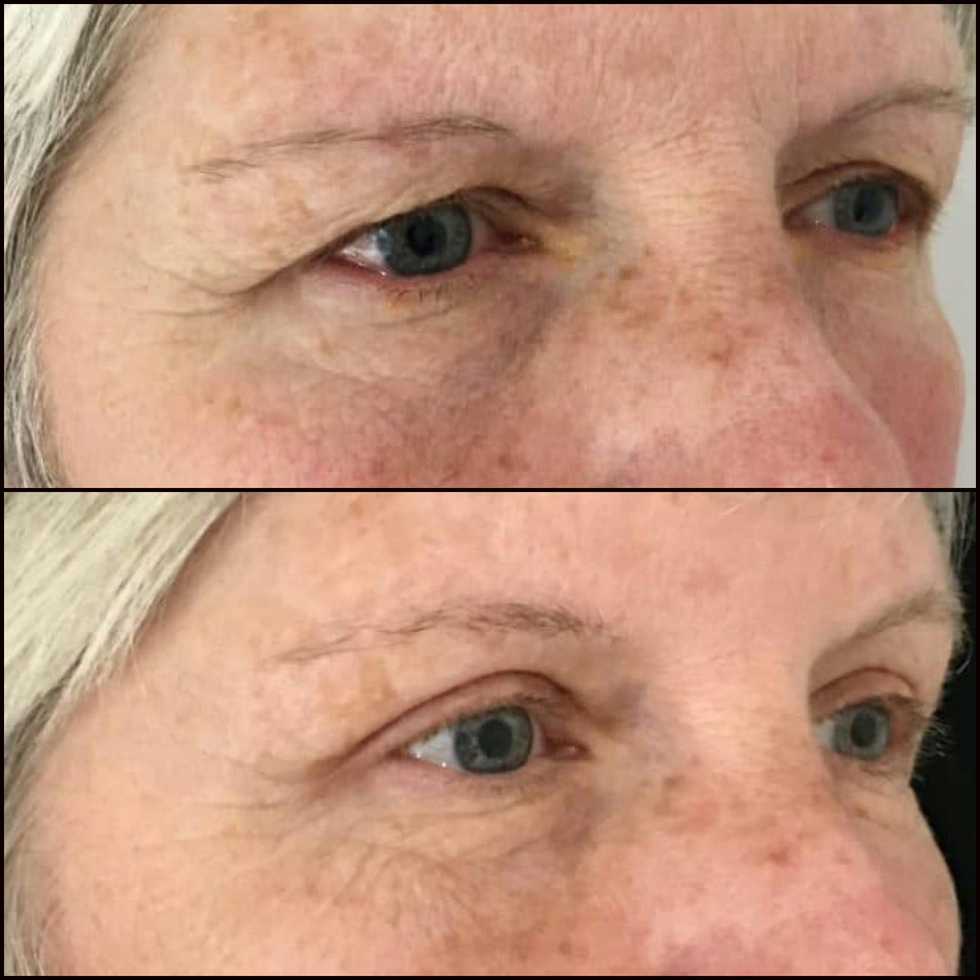 Brow Lift Before & After Gallery - Patient 53591934 - Image 3