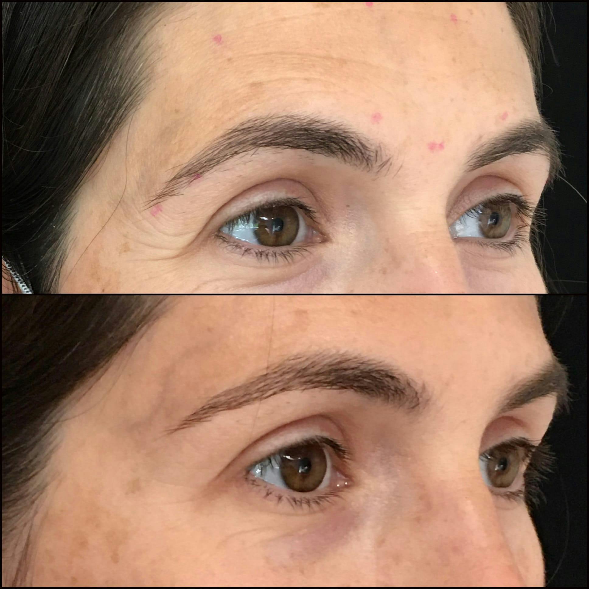 Brow Lift