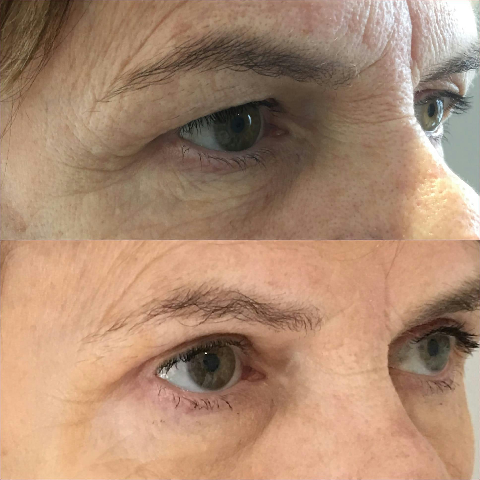 Brow Lift