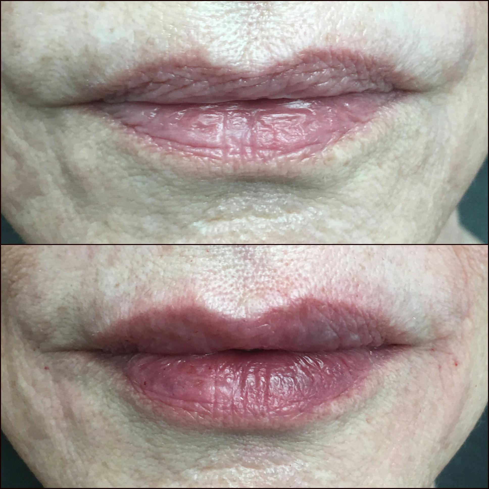 Lip Enhancement Gallery - Patient 53591940 - Image 1