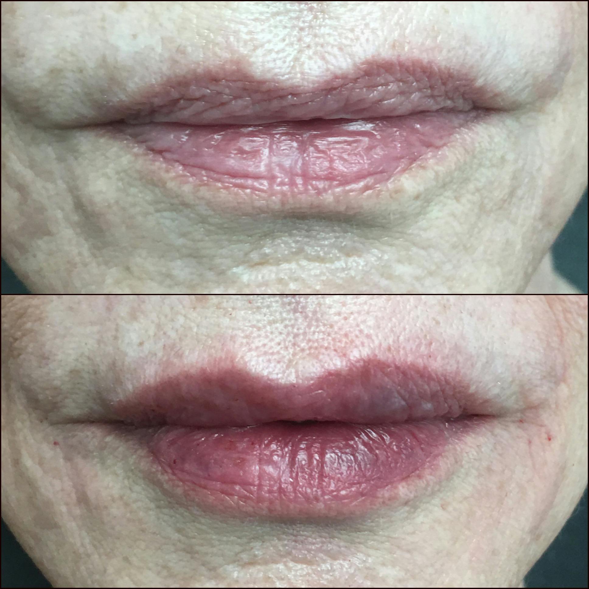 Lip Enhancement Before & After Gallery - Patient 53591940 - Image 1