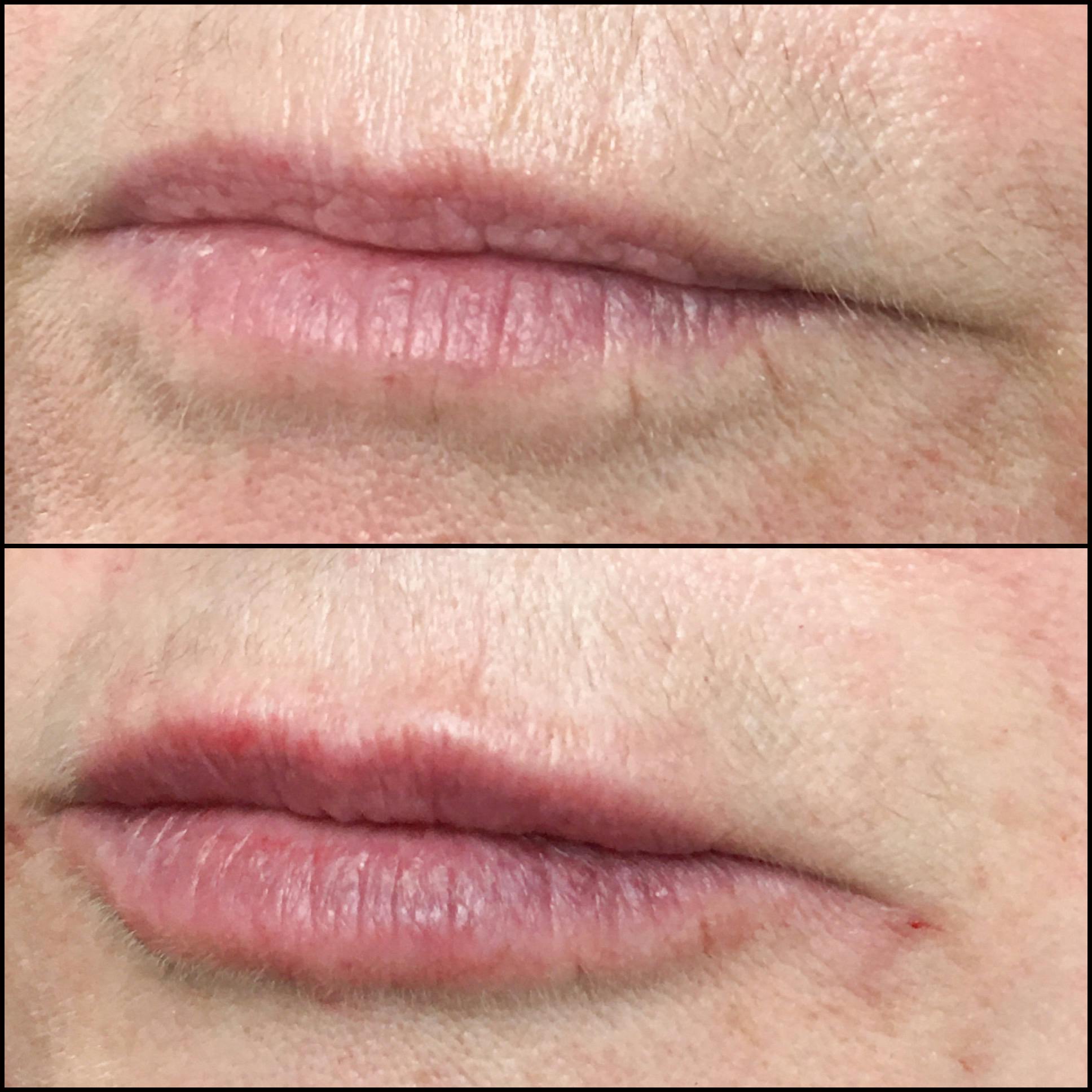 Lip Enhancement Before & After Gallery - Patient 53591941 - Image 1