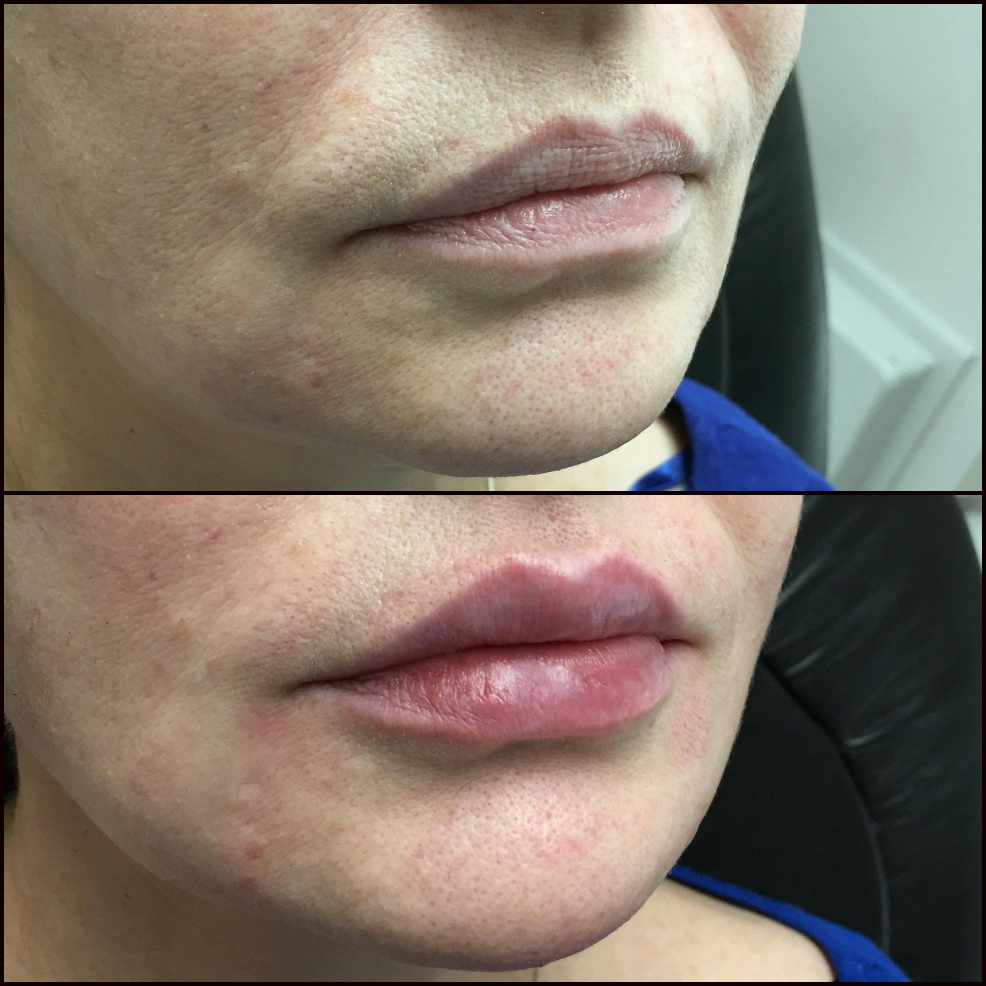 Lip Enhancement Before & After Gallery - Patient 53591942 - Image 1