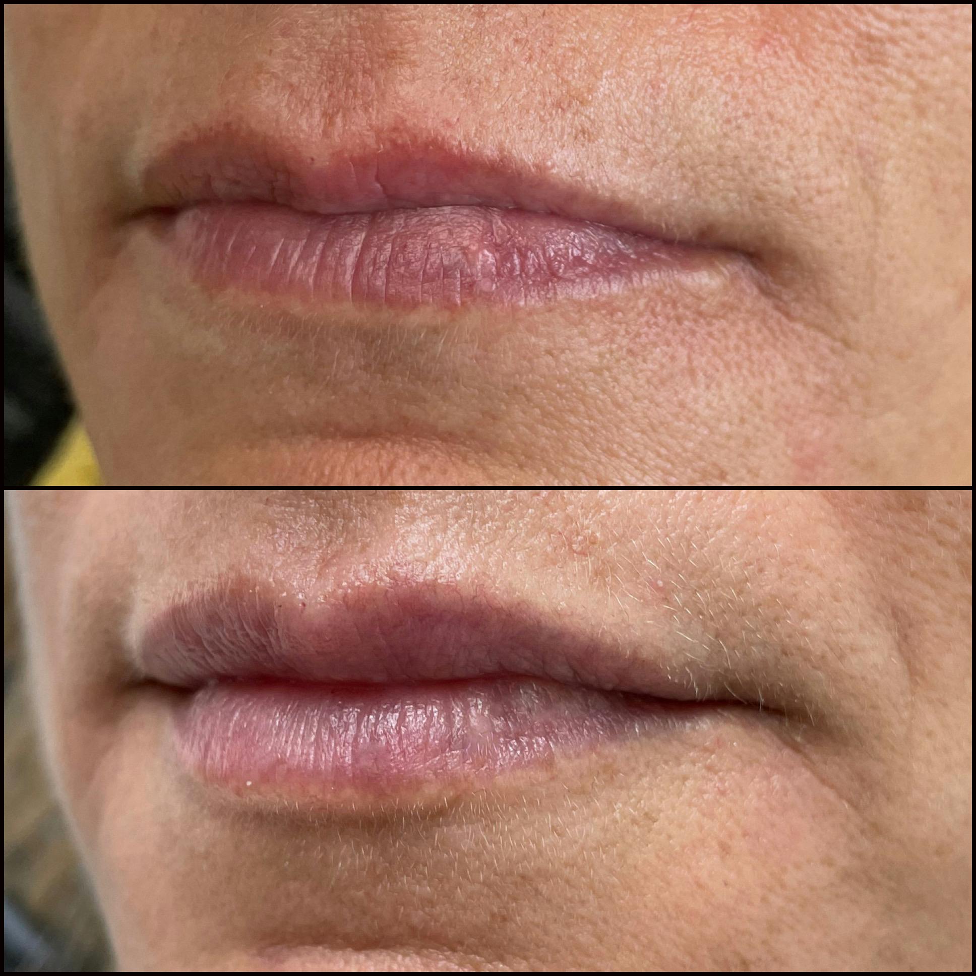 Lip Enhancement Before & After Gallery - Patient 53591943 - Image 1