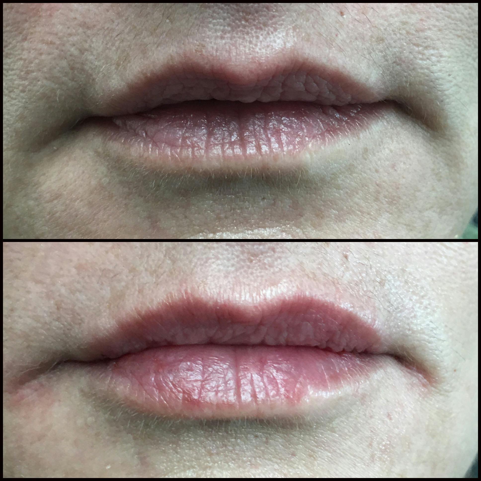 Lip Enhancement Before & After Gallery - Patient 53591944 - Image 1