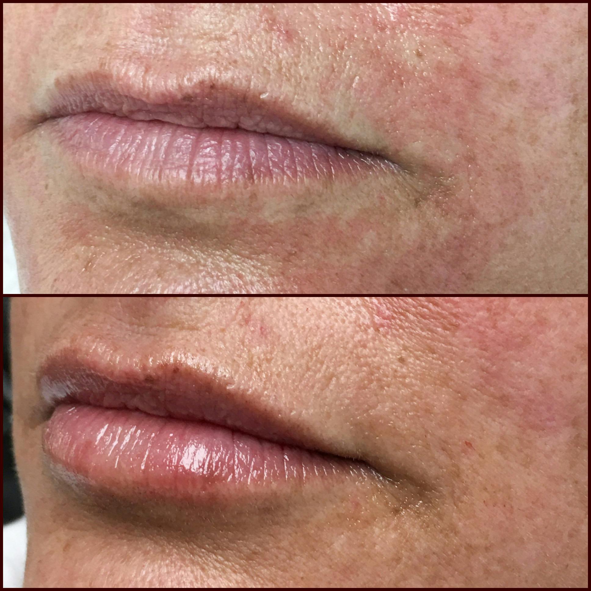 Lip Enhancement Before & After Gallery - Patient 53591947 - Image 1
