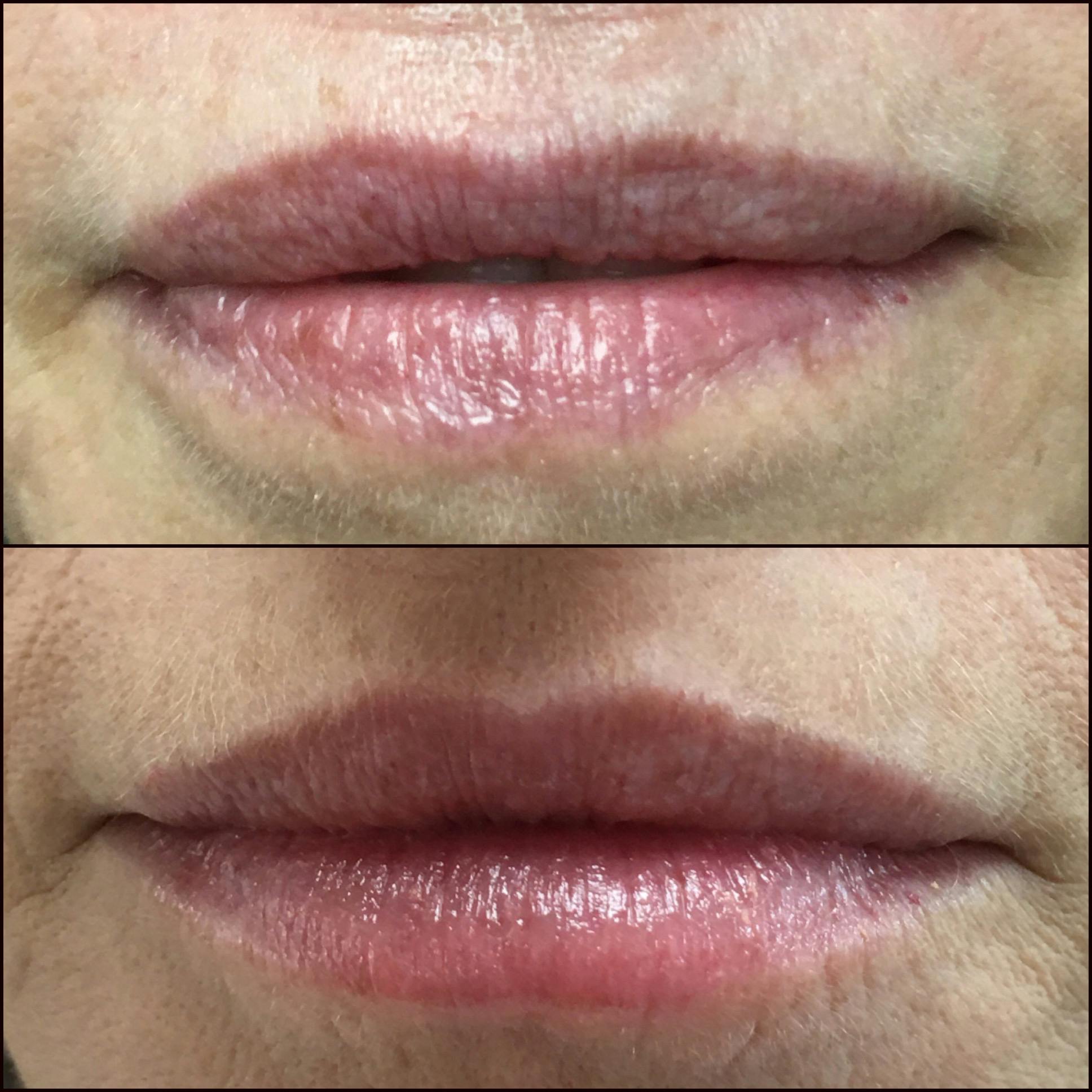 Lip Enhancement Before & After Gallery - Patient 53591948 - Image 1