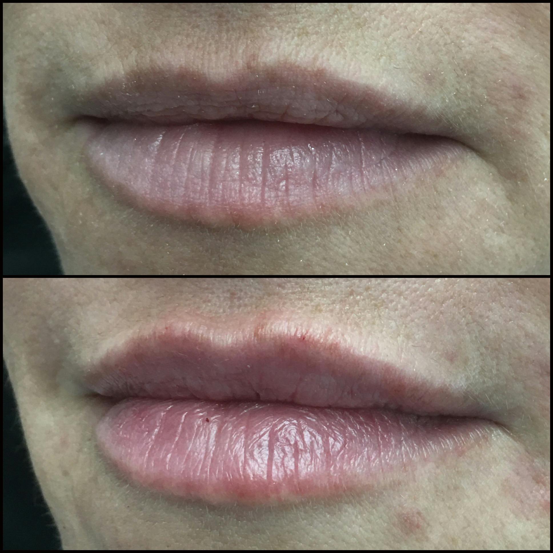 Lip Enhancement Before & After Gallery - Patient 53591950 - Image 1