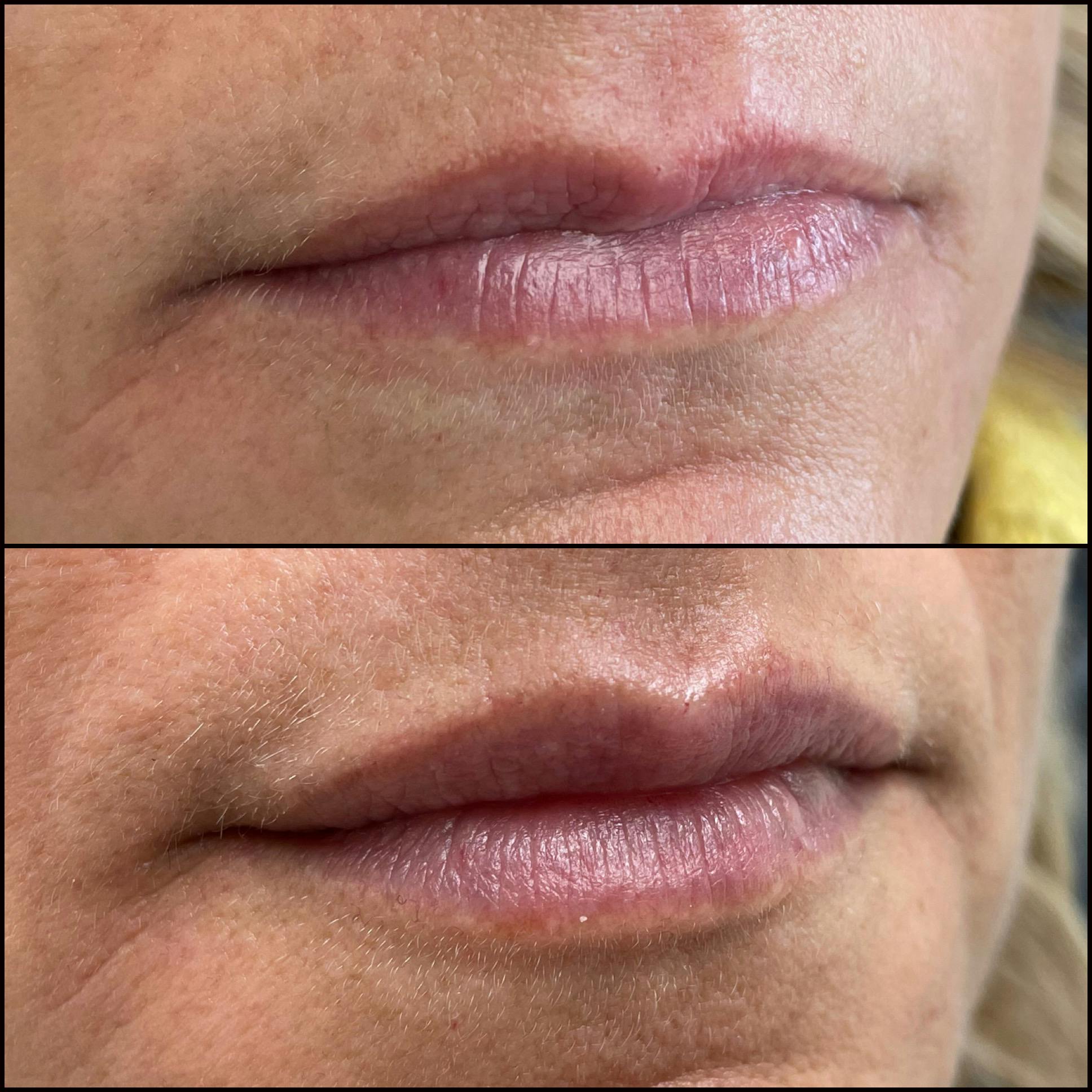 Lip Enhancement Before & After Gallery - Patient 53591951 - Image 1