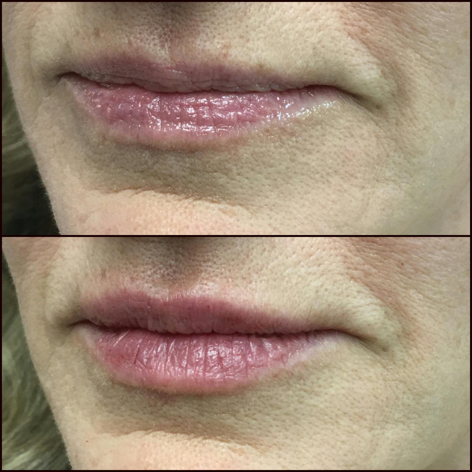 Lip Enhancement Before & After Gallery - Patient 53591952 - Image 1