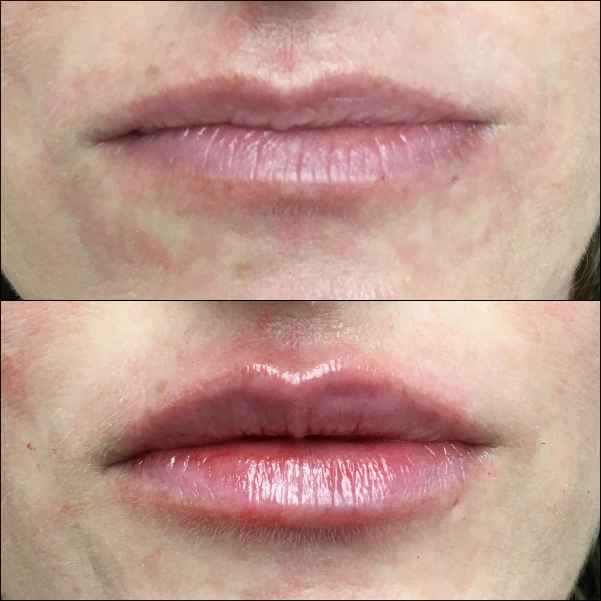 Lip Enhancement Before & After Gallery - Patient 53591954 - Image 1