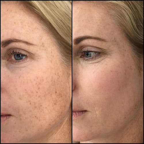 IPL before and after