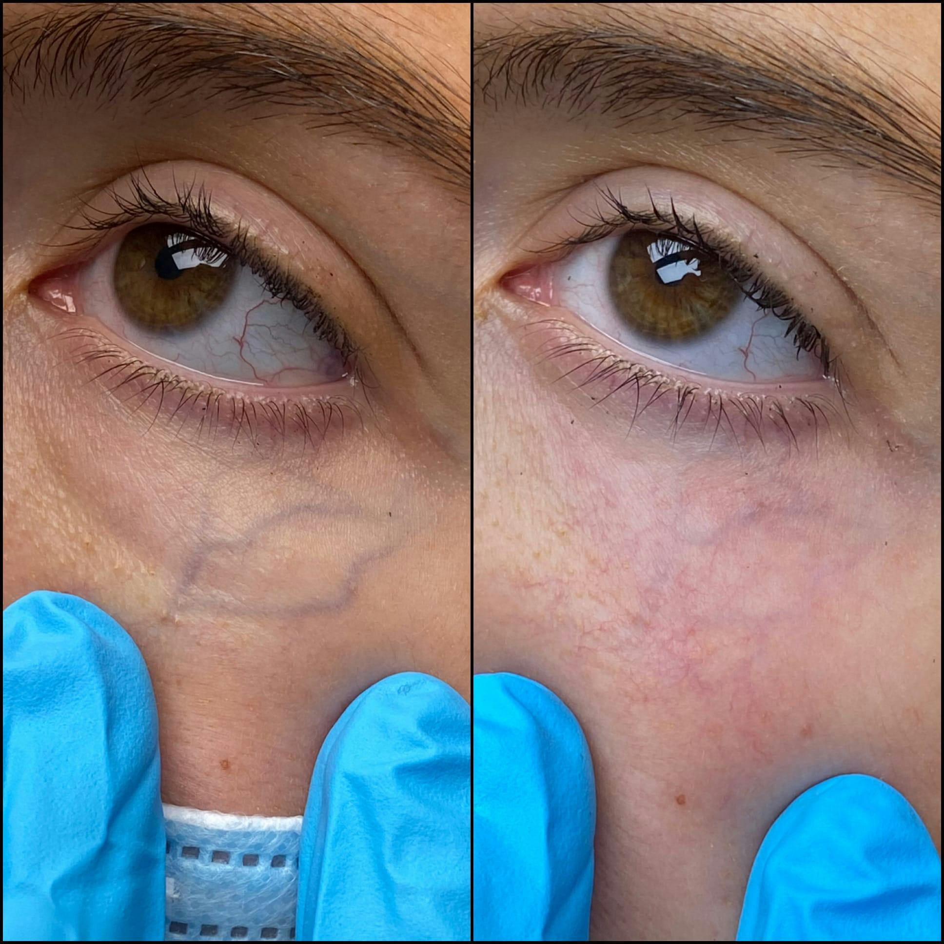 Under Eye Vein Treatment Before & After Gallery - Patient 53599447 - Image 1