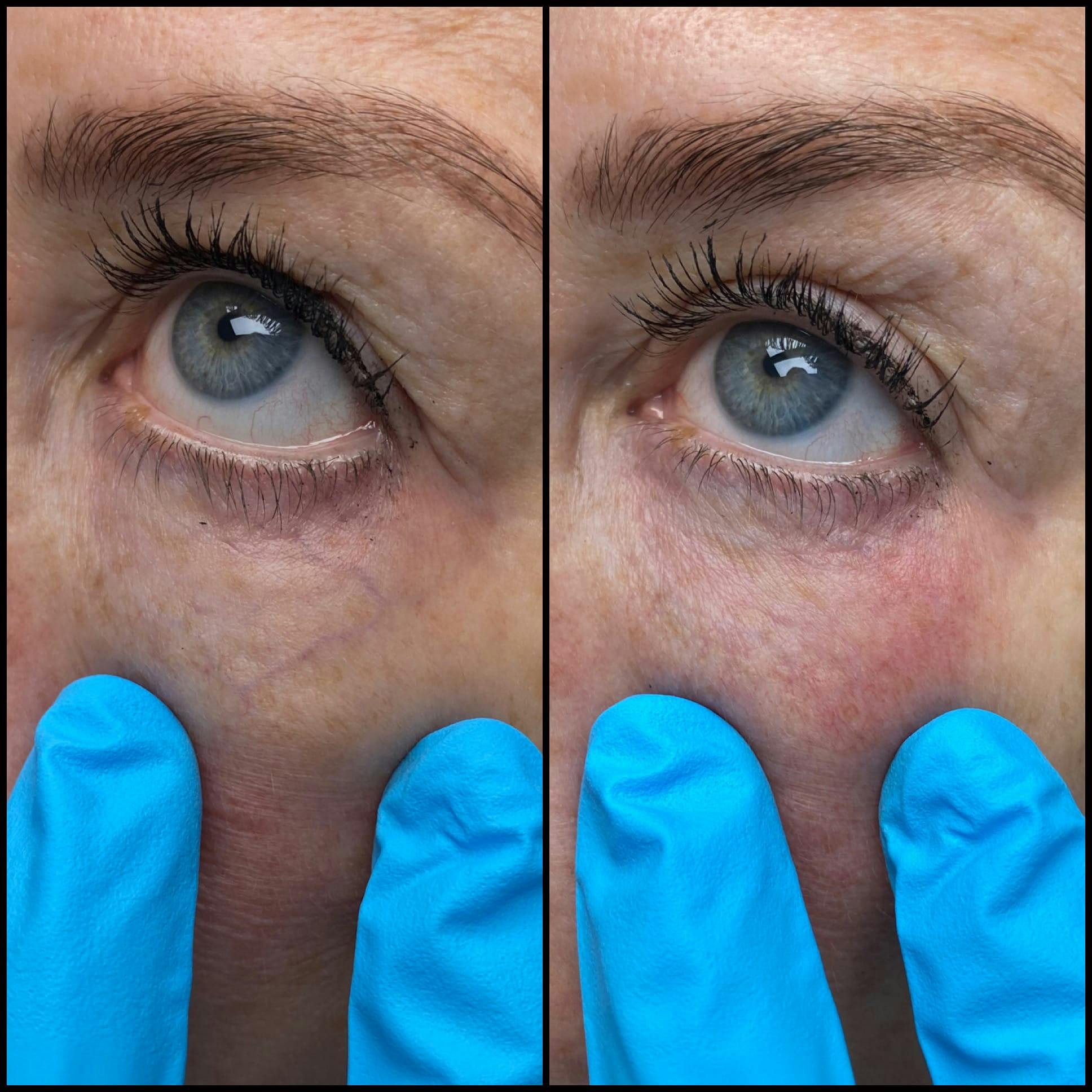 Under Eye Vein Treatment Before & After Gallery - Patient 53599448 - Image 1