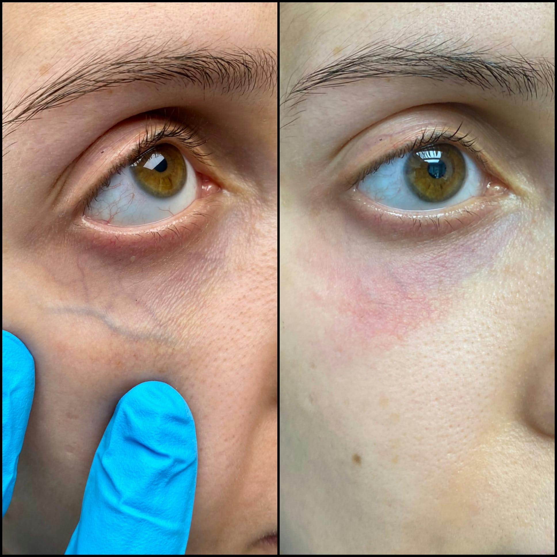 Under Eye Vein Treatment Before & After Gallery - Patient 53599449 - Image 1