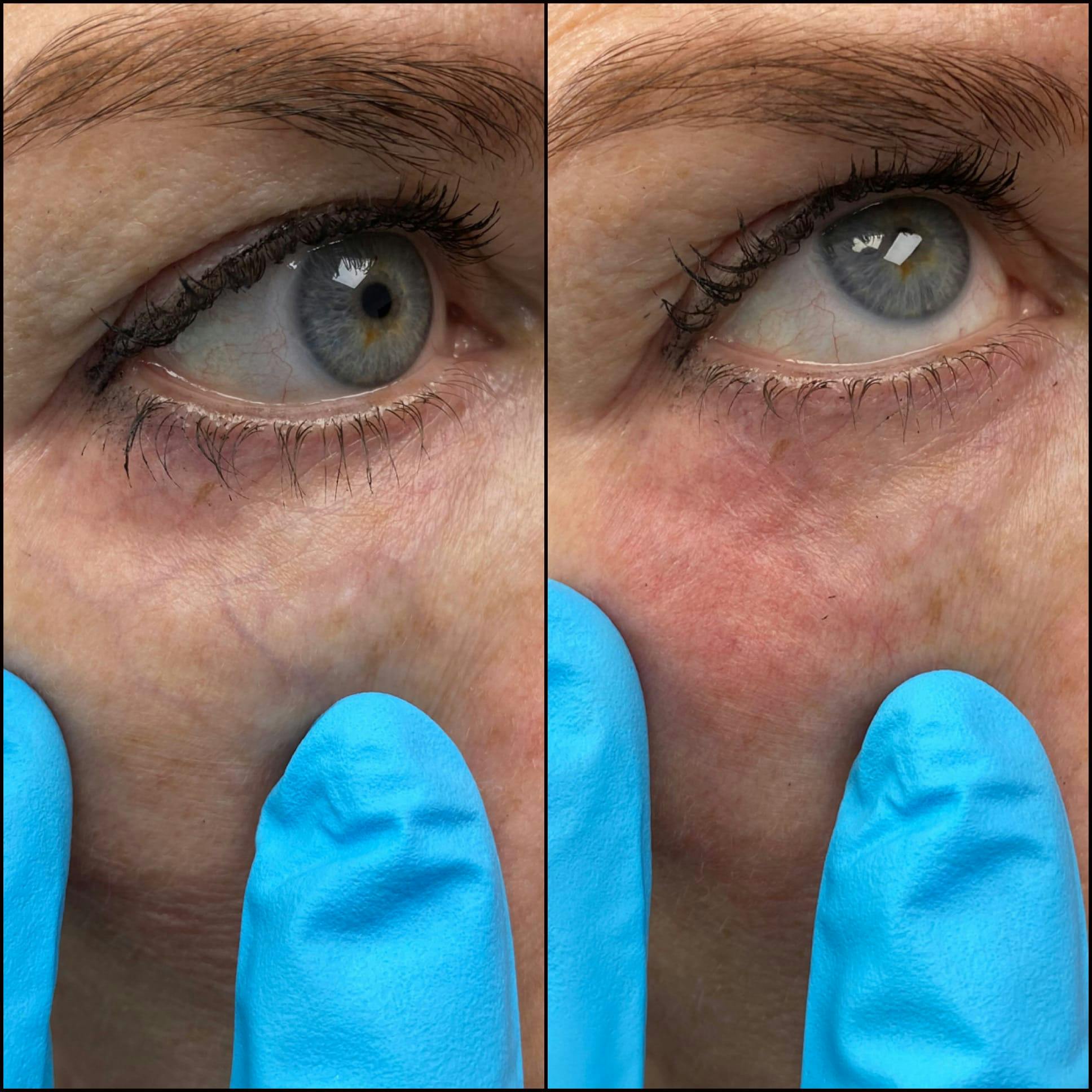 Under Eye Vein Treatment Before & After Gallery - Patient 53599450 - Image 1