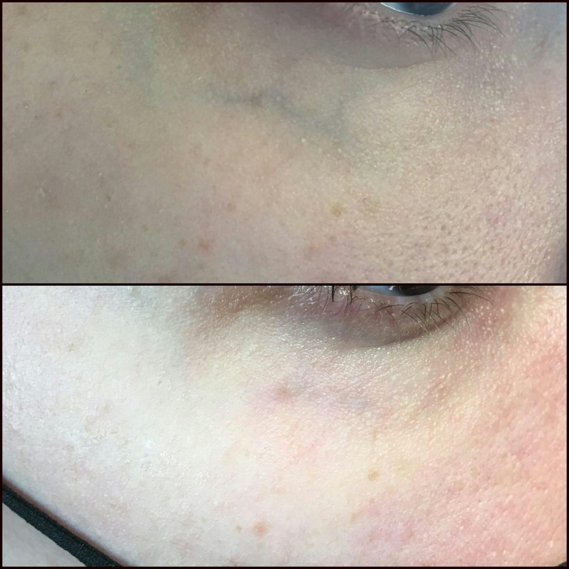 Under Eye Vein Treatment Before & After Gallery - Patient 53599452 - Image 1