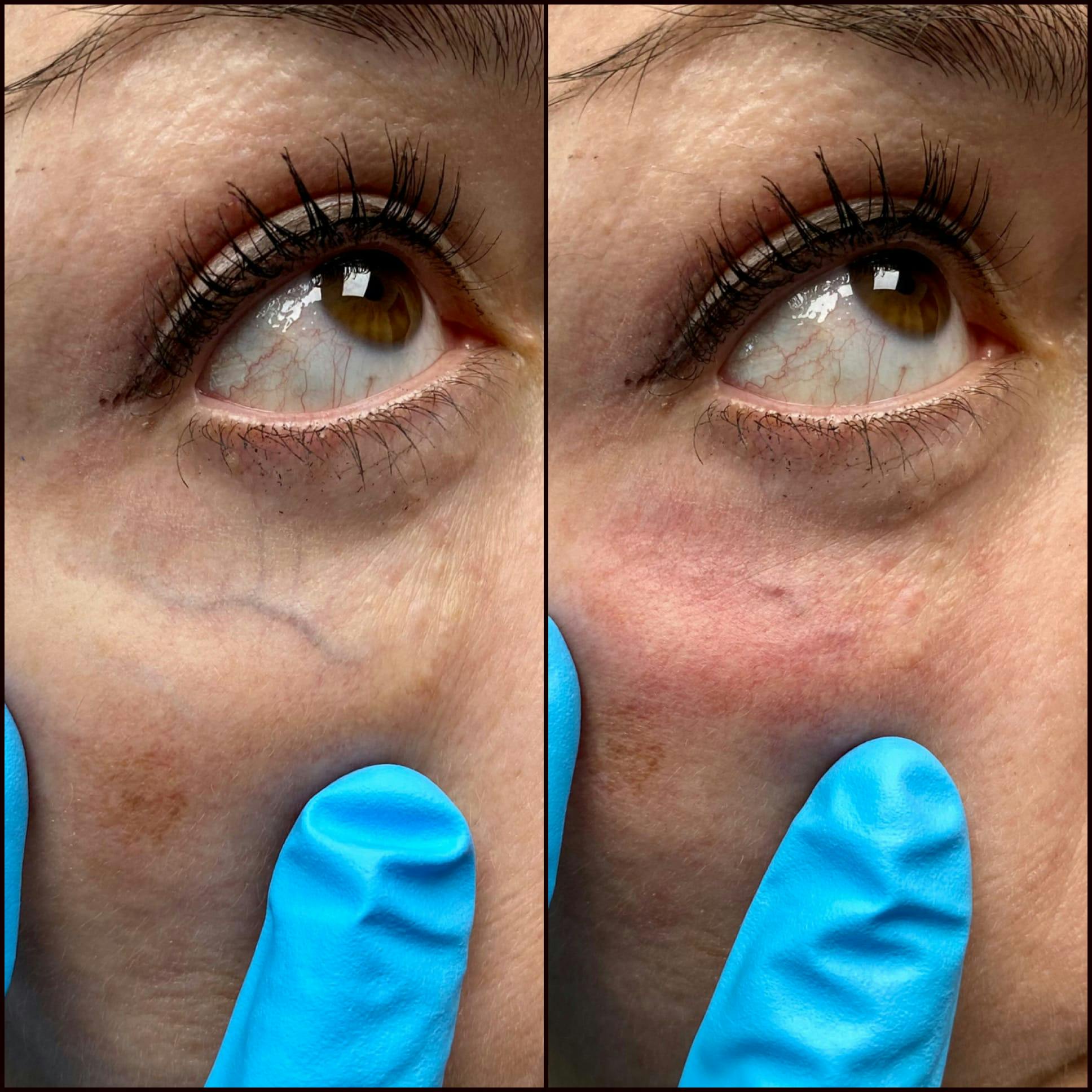 Under Eye Vein Treatment Before & After Gallery - Patient 53599451 - Image 1