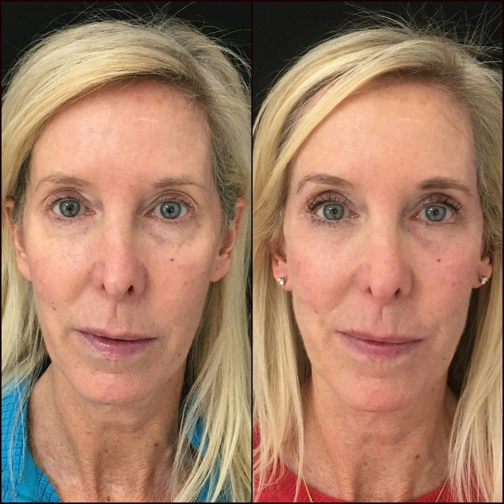 Upper & Lower Blepharoplasty Before & After Gallery - Patient 53819402 - Image 1