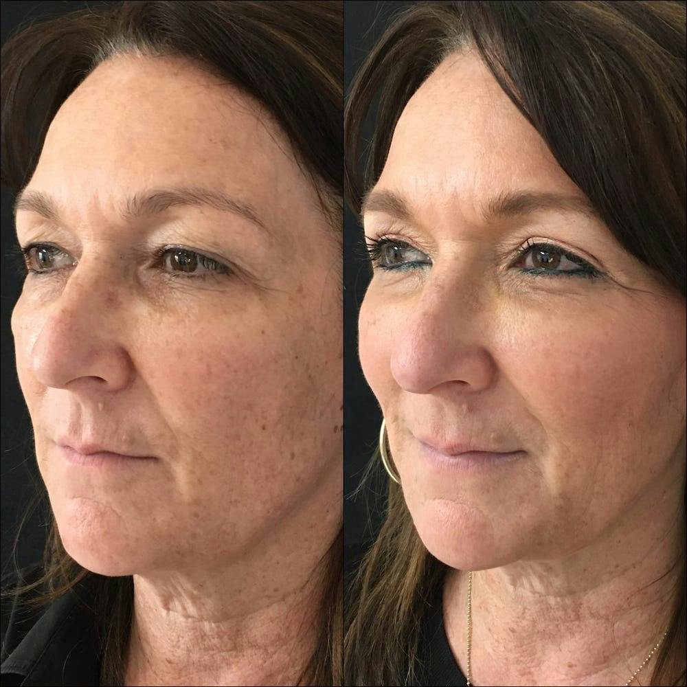 Patient 86224412 Upper & Lower Blepharoplasty with Fat Transfer