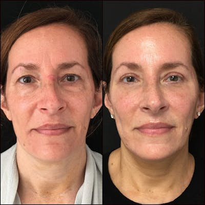 Upper & Lower Blepharoplasty Before & After Gallery - Patient 53819405 - Image 1