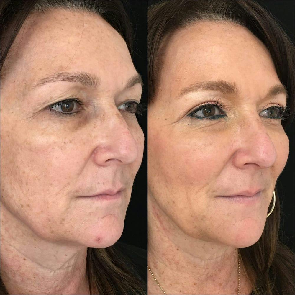 Upper & Lower Blepharoplasty Before & After Gallery - Patient 53819403 - Image 2