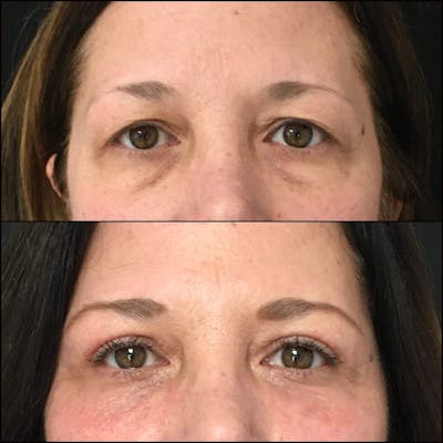 Upper & Lower Blepharoplasty Before & After Gallery - Patient 53819408 - Image 1