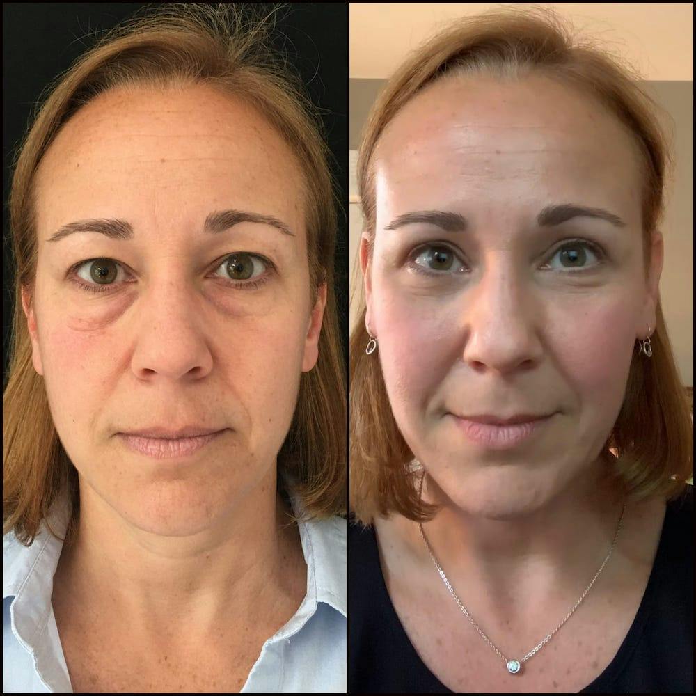 Facial Fat Transfer