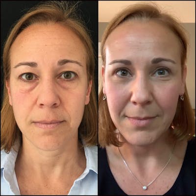 Lower Blepharoplasty Before & After Gallery - Patient 56142988 - Image 1