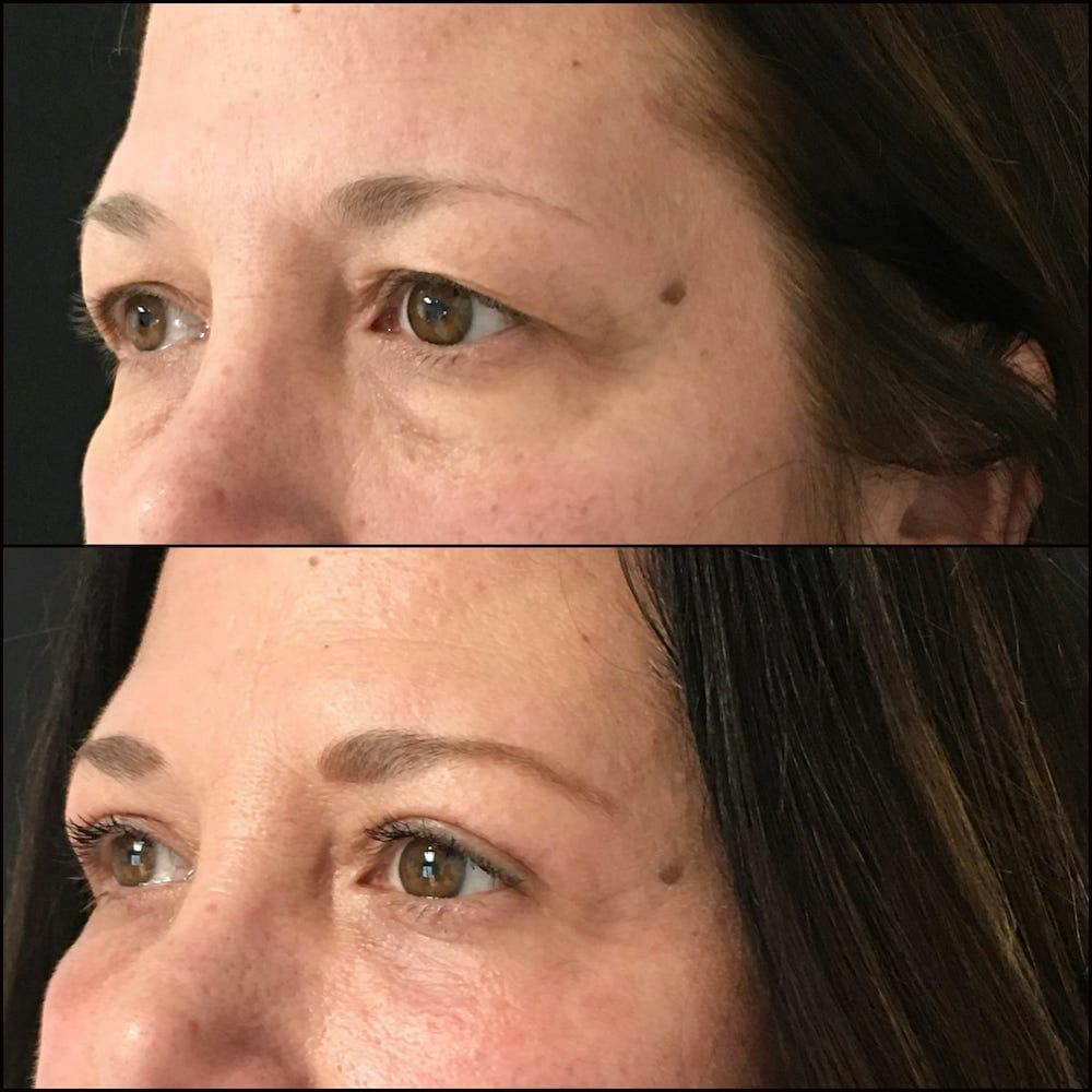 Upper & Lower Blepharoplasty<br> with Fat Transfer Gallery - Patient 53819408 - Image 2