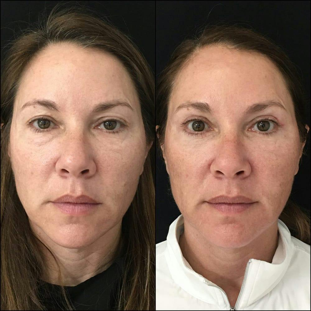 Upper & Lower Blepharoplasty<br> with Fat Transfer Gallery - Patient 53819410 - Image 1
