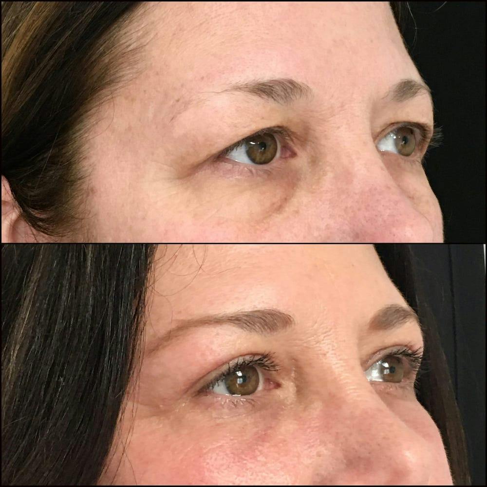 Upper & Lower Blepharoplasty Before & After Gallery - Patient 53819408 - Image 3