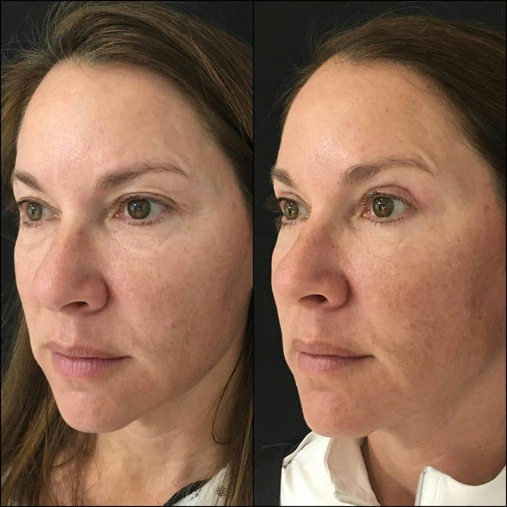 Upper & Lower Blepharoplasty Before & After Gallery - Patient 53819410 - Image 2