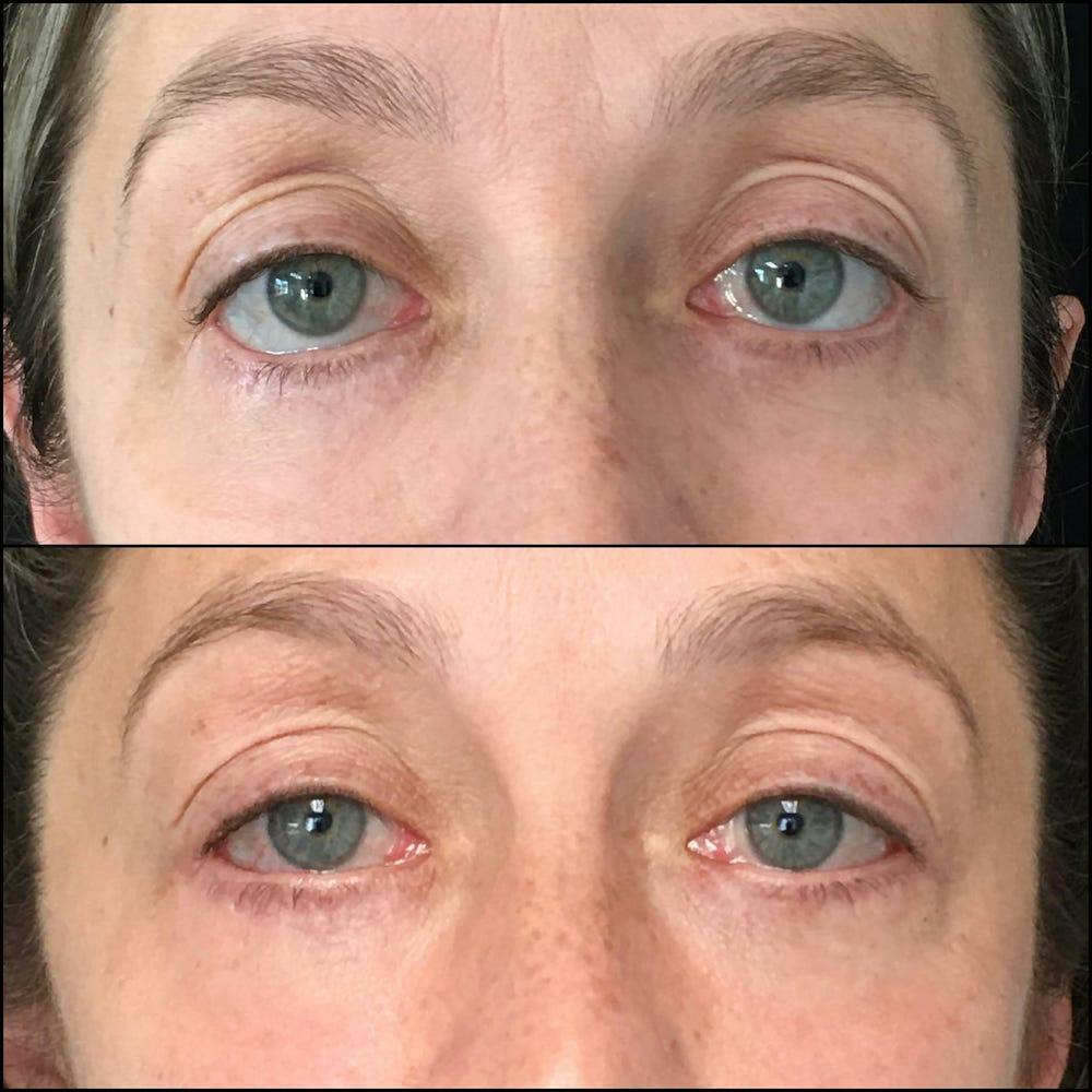 Revision Blepharoplasty